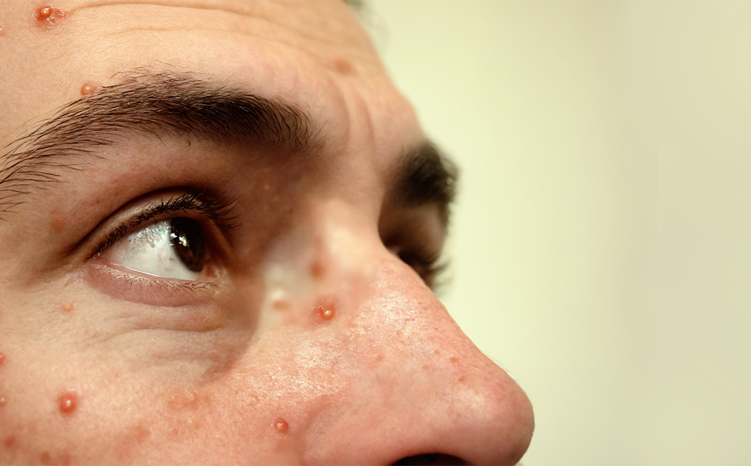 WHO has declared mpox a global health emergency. What happens next?